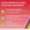 Dicloreum Ematosoll Gel 50 ml - Crema Gel per Ematomi