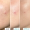 Centella Sos Patch - Trattamento Anti-Imperfezioni 9 ml