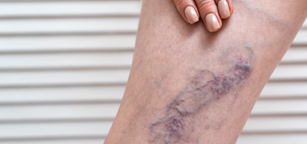 Categoria-Trattamento Cardiovascolare - Varici e Gambe pesanti